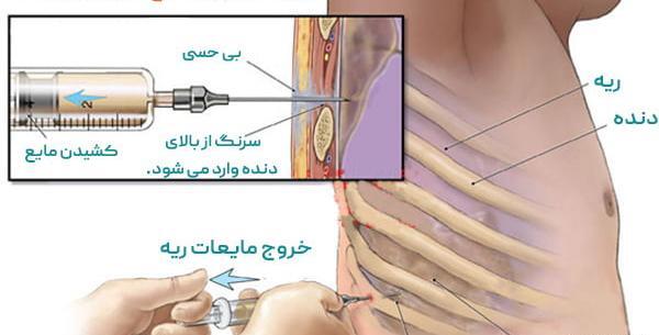عکس ریه که اب اورده