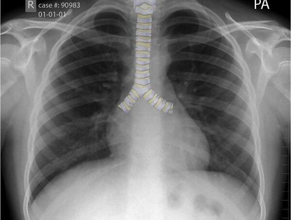 عکس ریه ی افراد سیگاری