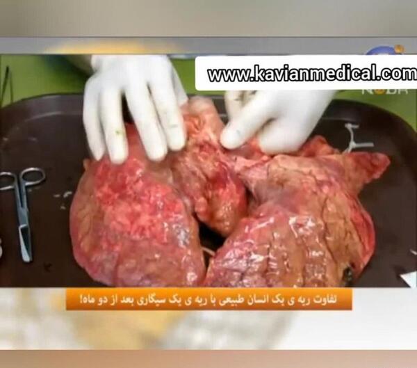 عکس ریه ی افراد سیگاری