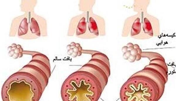 عکس از ریه عفونی