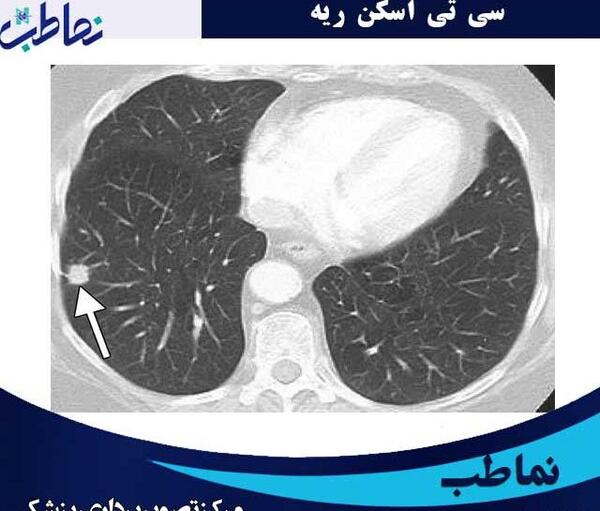 عکس ریه سالم ناسالم