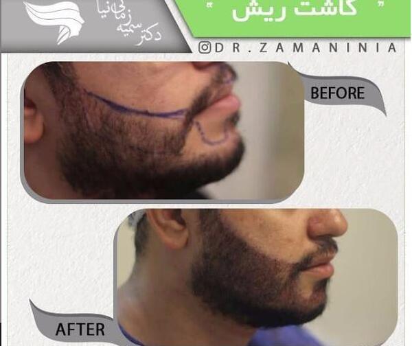 عکس خط ریش ستاری