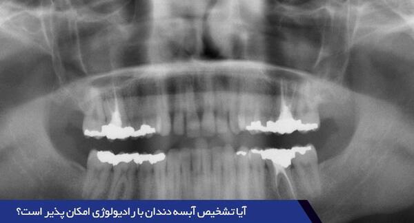 عکس ریشه دندان عفونی