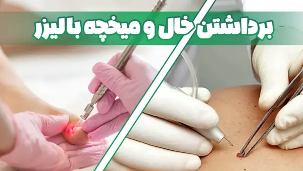 چسب ميخچه عکس ریشه میخچه پا