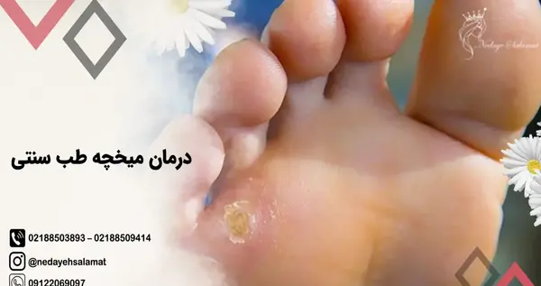 چسب ميخچه عکس ریشه میخچه پا
