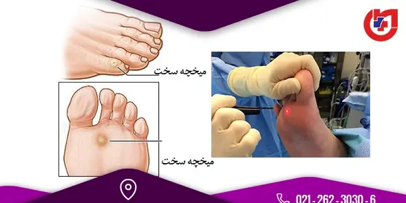 چسب ميخچه عکس ریشه میخچه پا