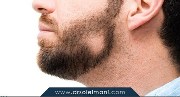 عکس ریزش سکه ای ریش