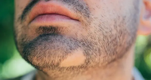 عکس ریزش سکه ای ریش