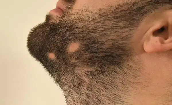 عکس ریزش سکه ای ریش