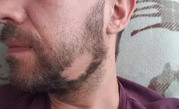 عکس ریزش سکه ای ریش