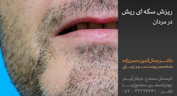 عکس ریزش سکه ای ریش
