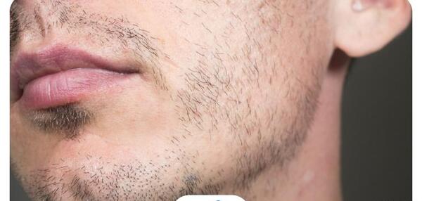 عکس ریزش سکه ای ریش