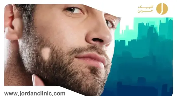 عکس ریزش سکه ای ریش
