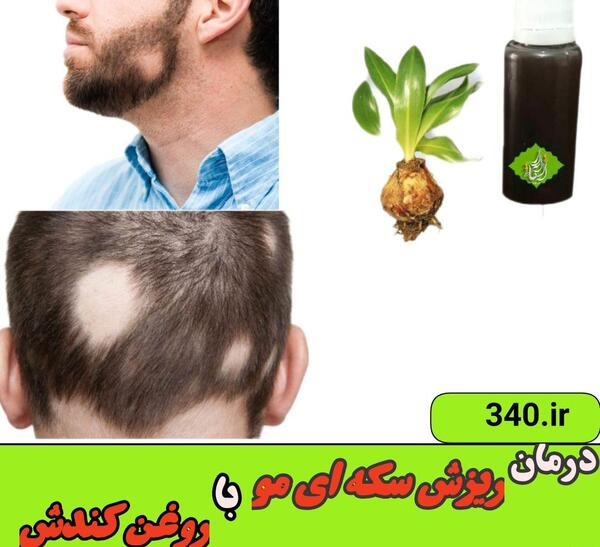 عکس ریزش سکه ای ریش