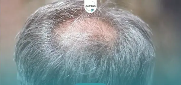 عکس ریزش مو از ریشه