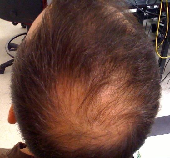 عکس ریزش مو از ریشه