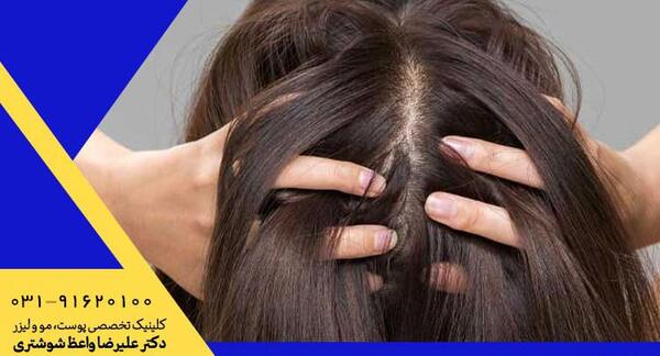 عکس ریزش مو از ریشه