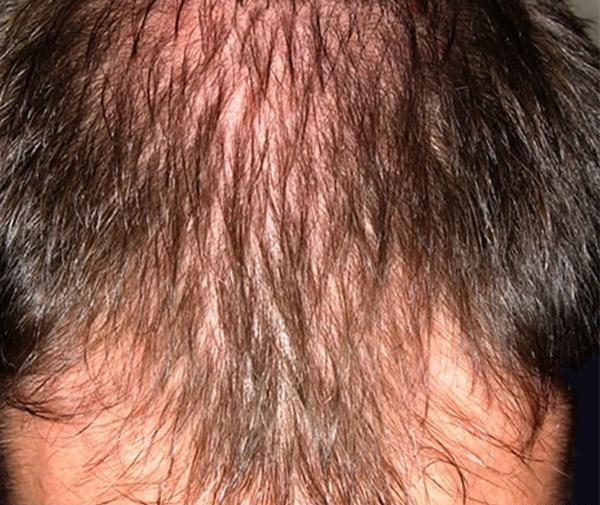 عکس ریزش مو از ریشه