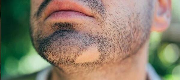 گوجه فرنگي عکس ریشه میخچه پا