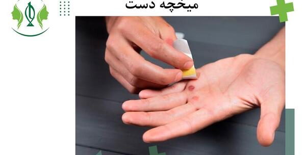 عکس ریشه میخچه دست