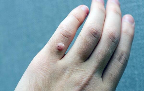 عکس ریشه میخچه دست