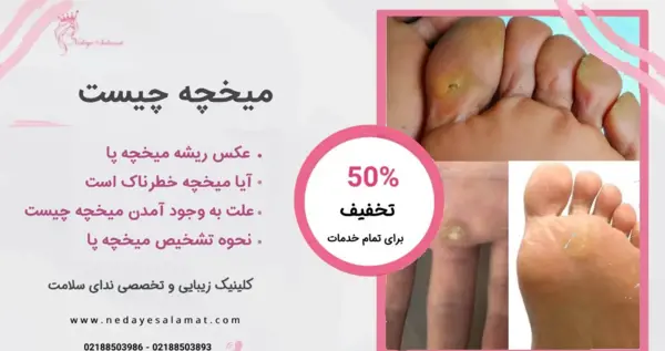 عکس ریشه میخچه دست