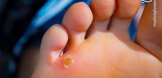 عکس ریشه میخچه دست