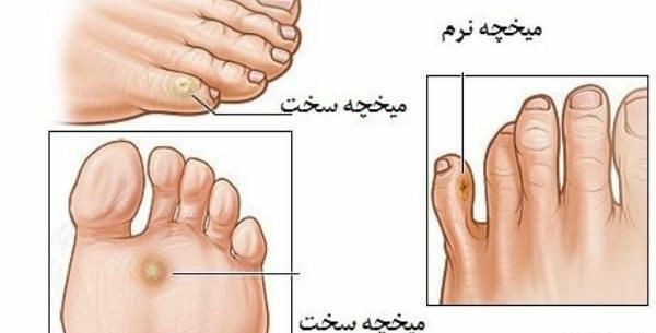 عکس از ریشه میخچه