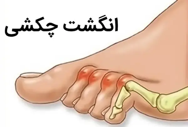 عکس از ریشه میخچه