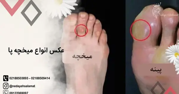 عکس ریشه میخچه انگشت دست