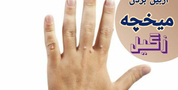 عکس ریشه میخچه انگشت دست