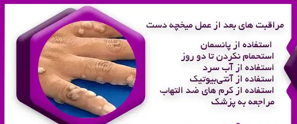 عکس ریشه میخچه انگشت دست