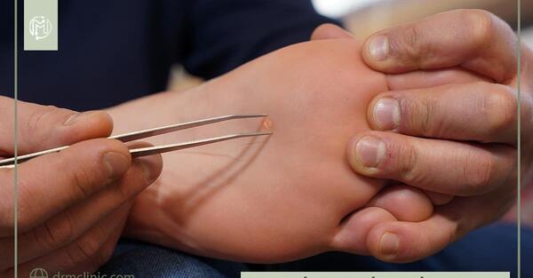 عکس ریشه میخچه انگشت دست