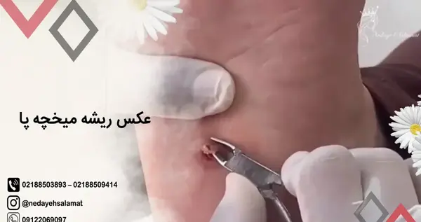 عکس ریشه های میخچه