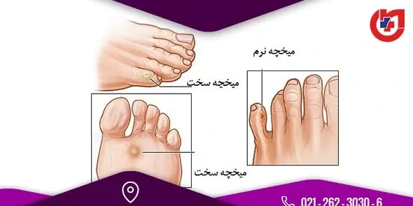 عکس ریشه های میخچه