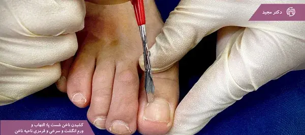 عکس ناخن دست افتاده