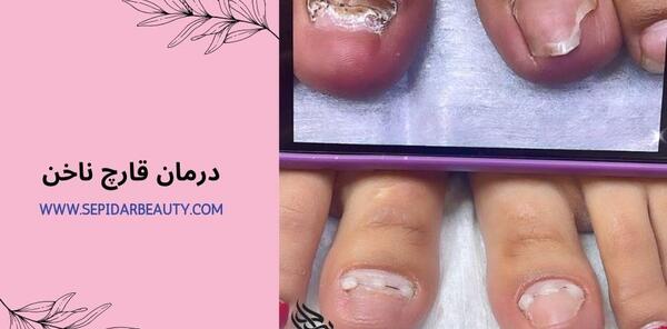 عکس ناخن پا قارچی