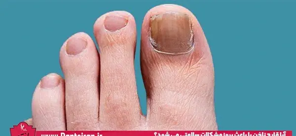 عکس ناخن پا قارچی