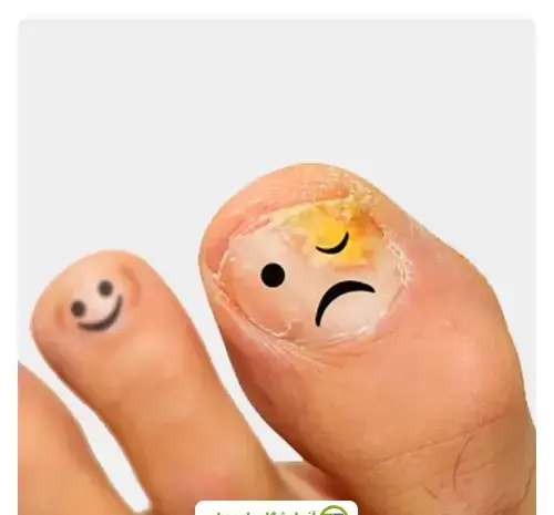 عکس عفونت قارچی ناخن