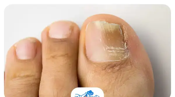 عکس عفونت قارچی ناخن