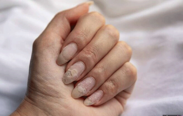 عکس عفونت قارچی ناخن