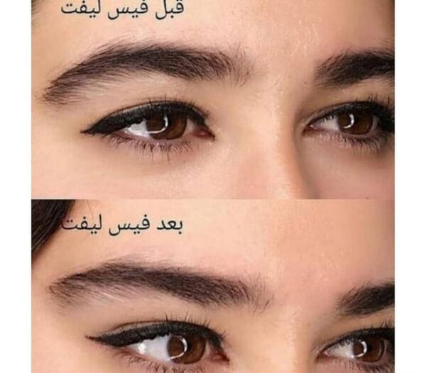 عکس لیفت ابرو مردانه