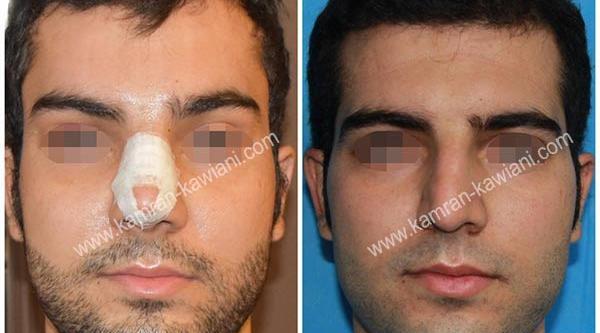 عکس لیفت ابرو مردانه