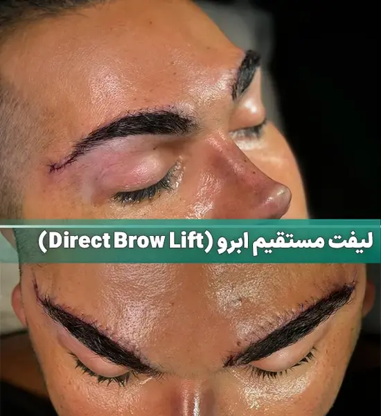 عکس لیفت ابرو مردانه