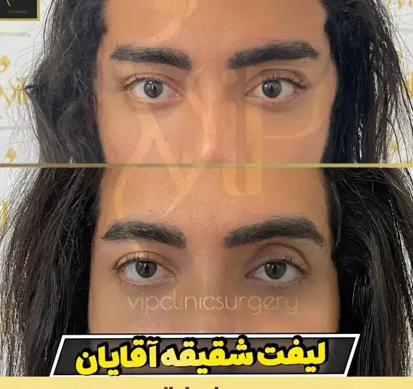 عکس لیفت ابرو مردانه