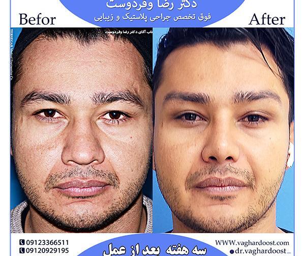 عکس لیفت ابرو مردانه