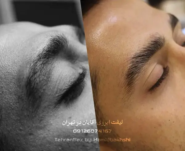 عکس لیفت ابرو مردانه