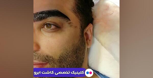 عکس کاشت ابرو مردانه