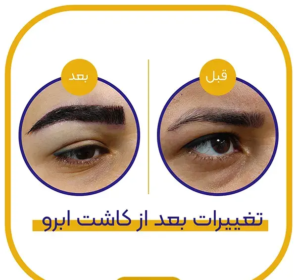 عکس کاشت ابرو مردانه