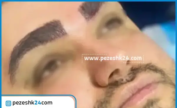 عکس کاشت ابرو مردانه